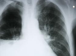 radiografia polmoni cancro